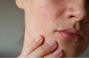 毛孔粗大保養品毛孔清潔Dr. Medion碳酸面膜