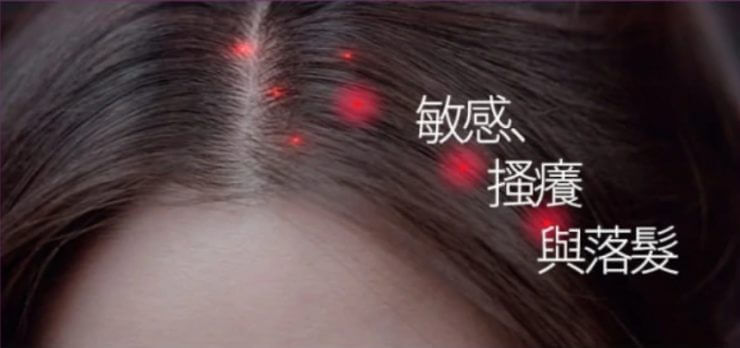 頭皮癢 頭皮屑 去屑止癢洗髮精 頭皮癢 洗髮精 頭皮發炎怎麼辦 頭皮癢 洗髮精推薦 頭皮癢頭皮發炎怎麼辦 頭皮癢脫髮